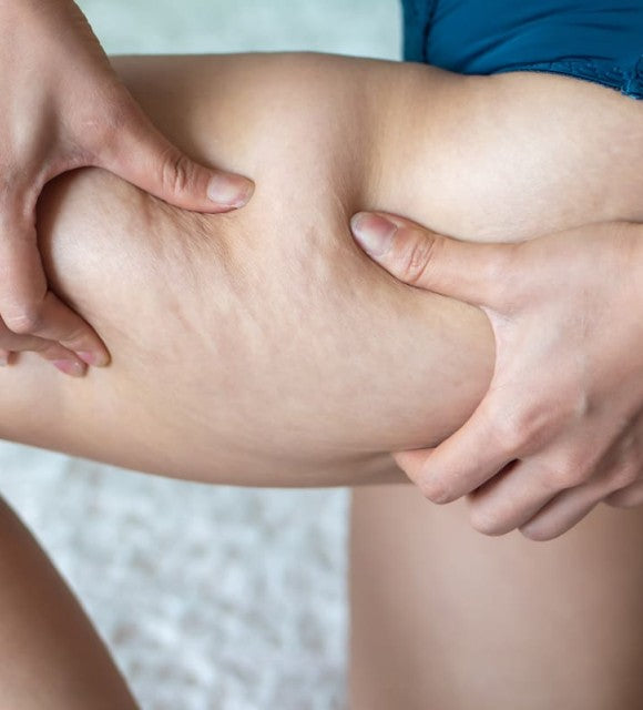 Le CBD peut-il aider à estomper la cellulite ? Voici notre réponse