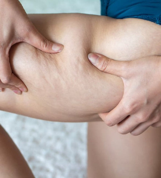 Le CBD peut-il aider à estomper la cellulite ?  Voici notre réponse